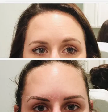 Brow-Lift-gallery-angelicajackson-in-houston-TX