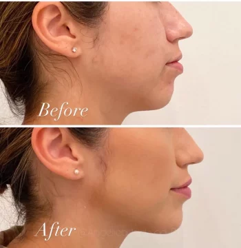 Chin-Augmentation-gallery-angelicajackson-in-houston-TX