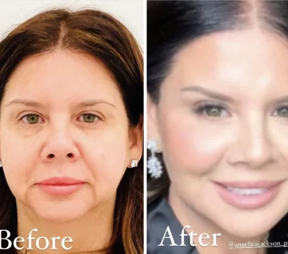 Facial-Balancing-gallery-angelicajackson-in-houston-TX