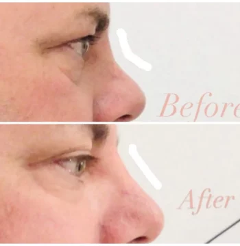 Non-Surgical-Rhinoplasty-gallery-in-houston-TX